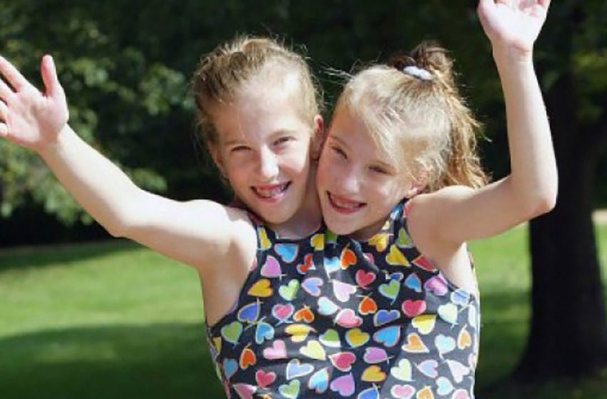  La historia increíble de los gemelos siamesas! Cómo viven las hermanas Hensel y qué hacen ahora!