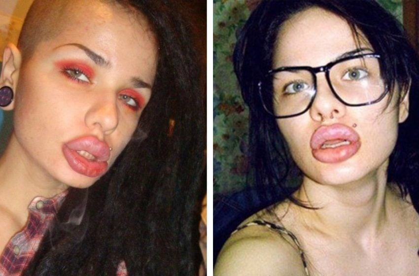  Fueron demasiado en la búsqueda de la belleza: chicas que arruinaron su apariencia drásticamente con el aumento de labios
