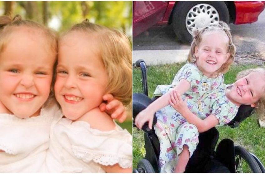  Estos gemelos siameses fueron separados a los 4 años, ahora tienen 18 años. ¿Cómo están viviendo ahora?