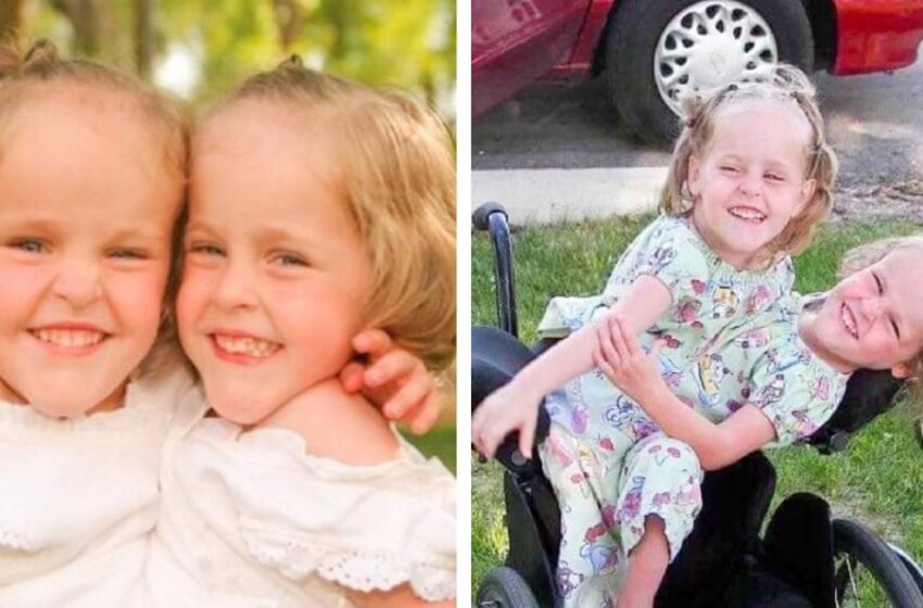  Dessa siamesiska tvillingar separerades när de var 4 år gamla: Hur mår de nu?