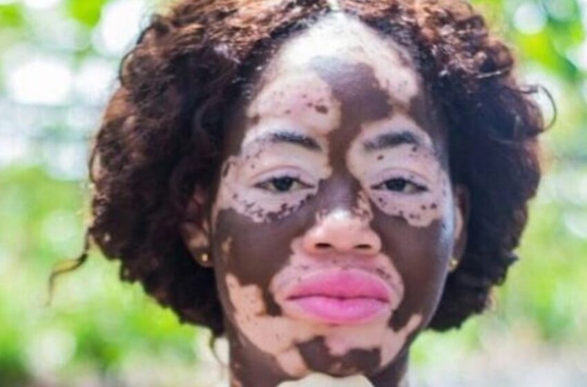  “Folk Trodde Att Hon Var Dränkt i Syra”: En Unik Tjej Med Vitiligo Som Erövrar Världen Delar Sina Fullängdsbilder!