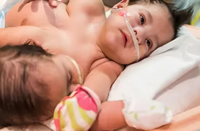  Den Otroliga Historien om Siamesiska Tvillingar som Övervann Oddsen! Hur Ser de Ut Idag?